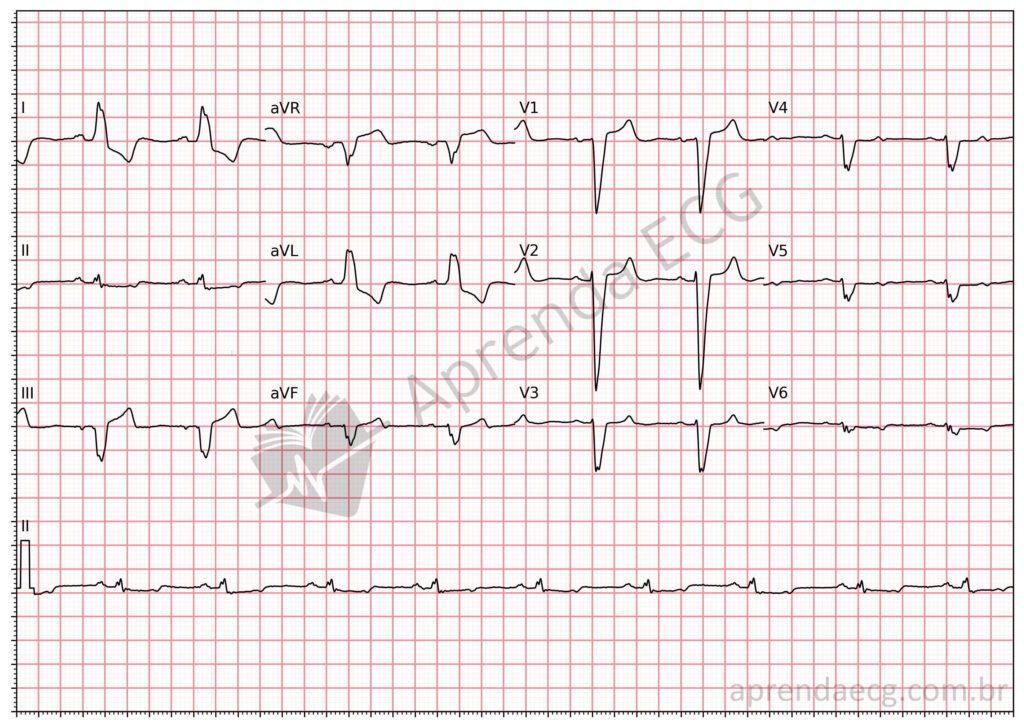 Electrocardiogram showing left bundle branch block with ST-segment changes suggestive of occlusion myocardial infarction