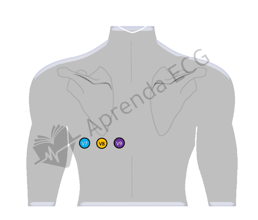 Electrocardiographic leads V7, V8 and V9