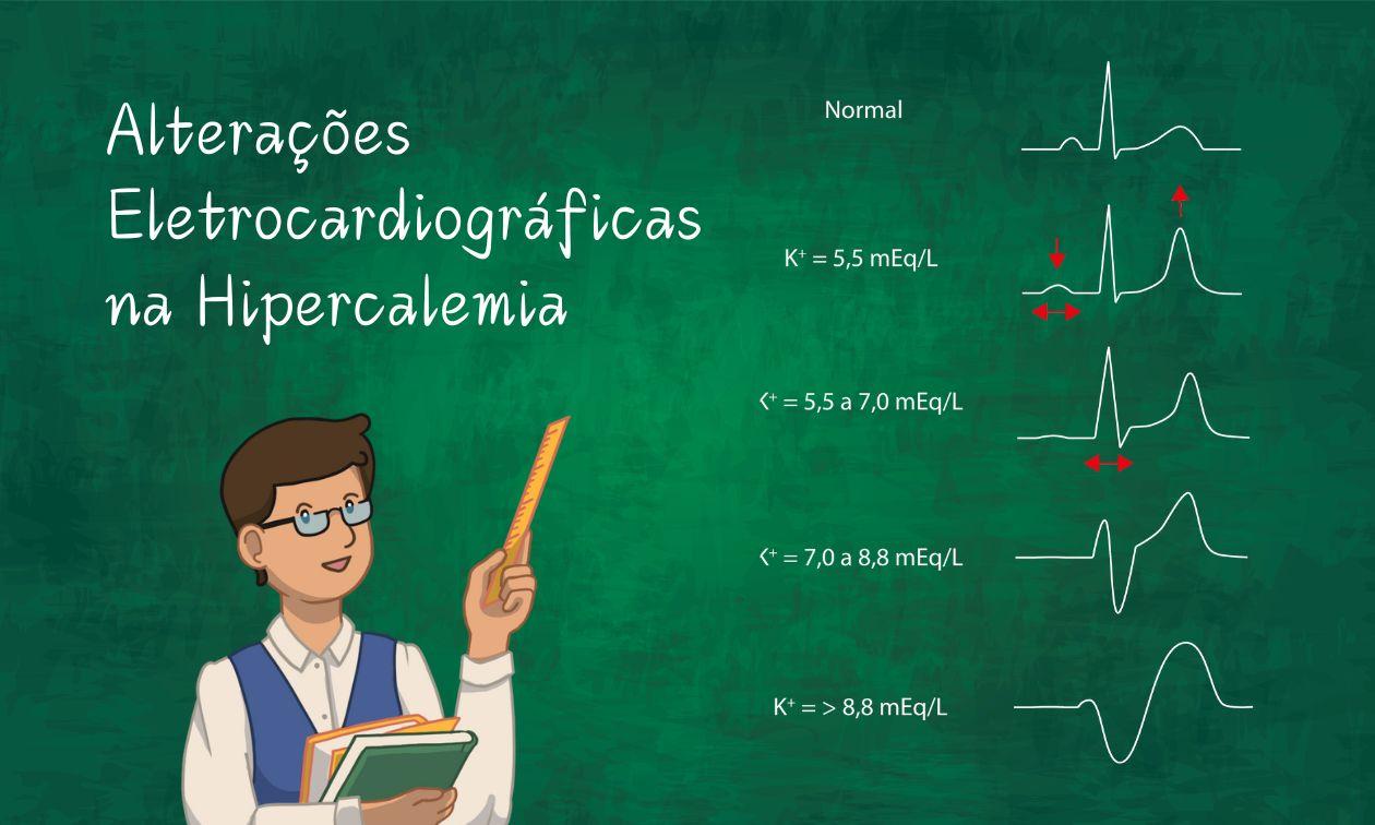 Hyperkalemia and its electrocardiographic changes: how the ECG reflects serum potassium levels