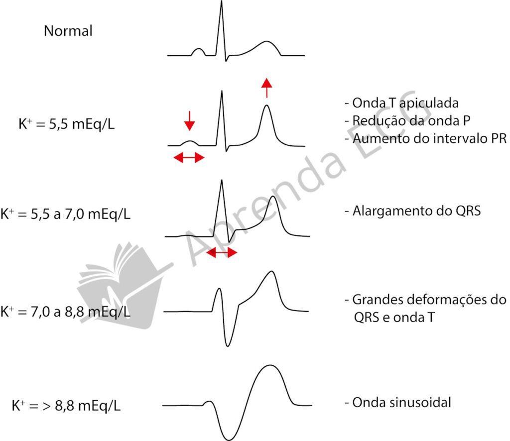 ECG changes in hyperkalemia