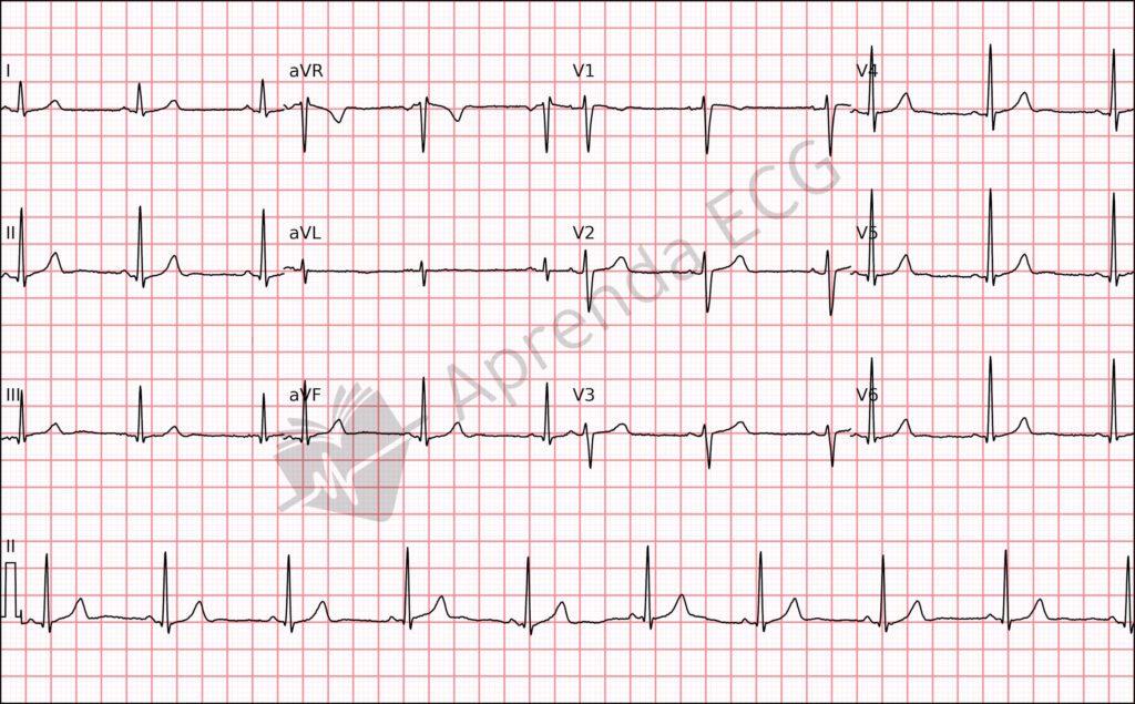 Electrocardiogram with sinus rhythm