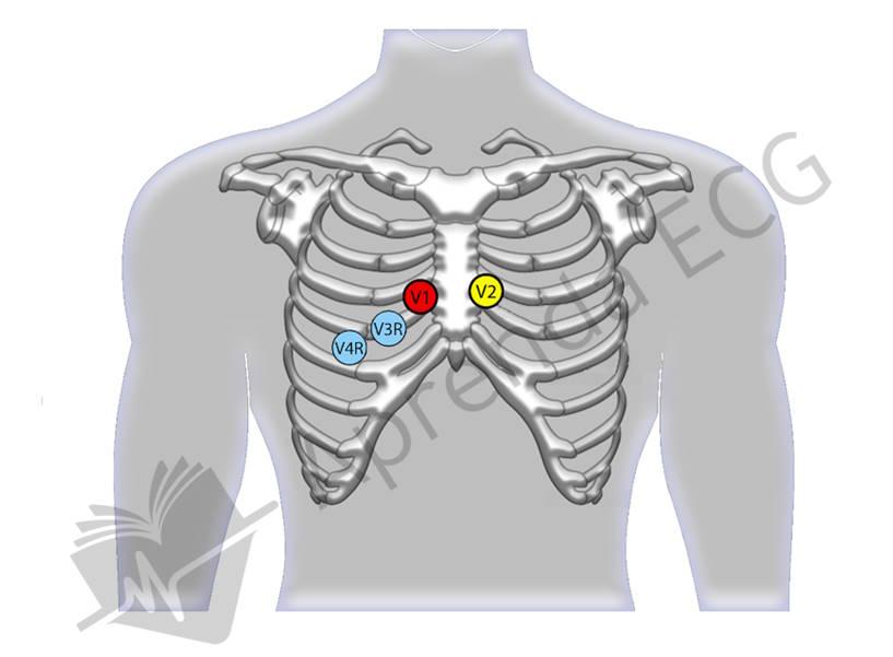 Electrocardiographic leads V3R and V4R