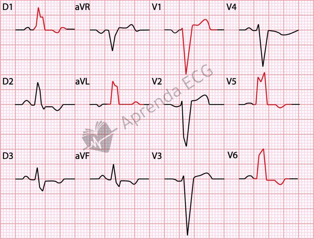 Left bundle branch block