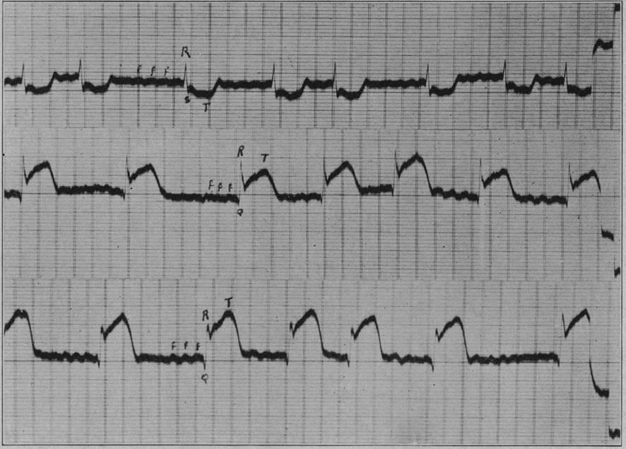ST-segment elevation demonstrated by Pardee in 1920 after an acute coronary occlusion.