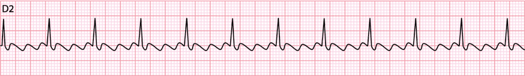 Lead II rhythm strip in atrial flutter with negative sawtooth F waves and regular narrow QRS complexes