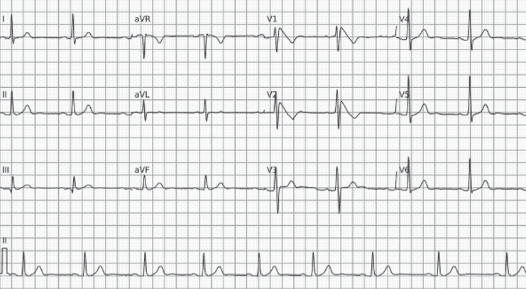 Type 1 Brugada pattern. Typical morphology of the type 1 Brugada pattern in leads V1 and V2, with coved ST-segment elevation > 2 mm followed by a straight descent and a negative T wave.