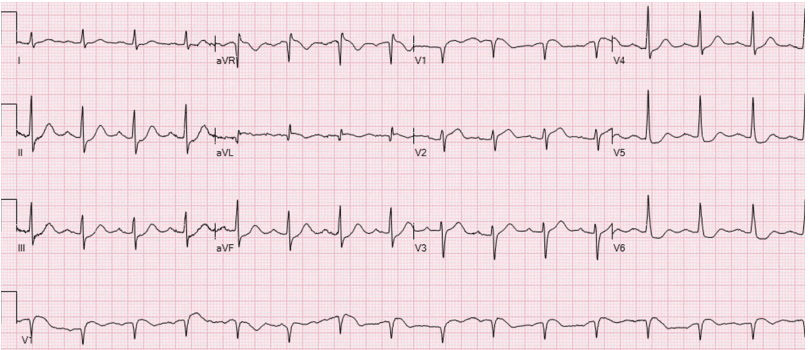 ECG showing the Precordial Swirl pattern, with ST depression in V5 and V6, ST elevation in aVR, and ST elevation/hyperacute T waves in V1 and V2, including a T/S ratio ≥ 0.4 in V2, which strengthens the diagnostic power of this electrocardiographic pattern. There is also reciprocal ST depression in II, III, and aVF. Note that the QRS is normal.