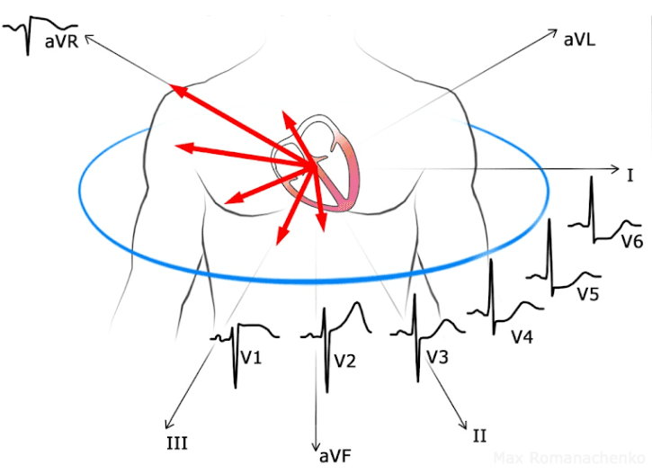 Diagram of the precordial swirl pattern: repolarization vector directed rightward and toward the septum, with ST elevation in V1 and aVR