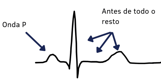 Schematic PQRST complex with an arrow pointing to the P wave, the first deflection of the cycle, before the QRS and the T wave