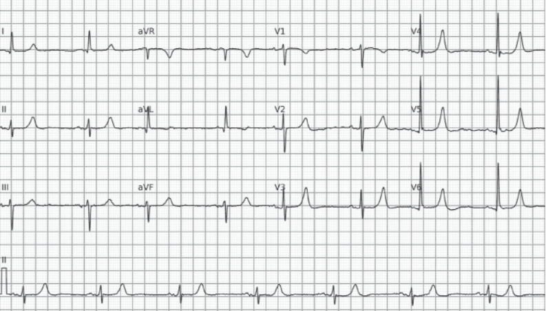 Hyperkalemia. Note the peaked T waves that are symmetric in themselves.
