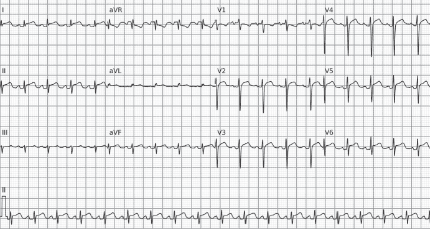 Acute pericarditis. The electrocardiogram shows sinus tachycardia, diffuse ST-segment elevation, ST-segment depression in V1 and aVR, and PR-segment depression.
