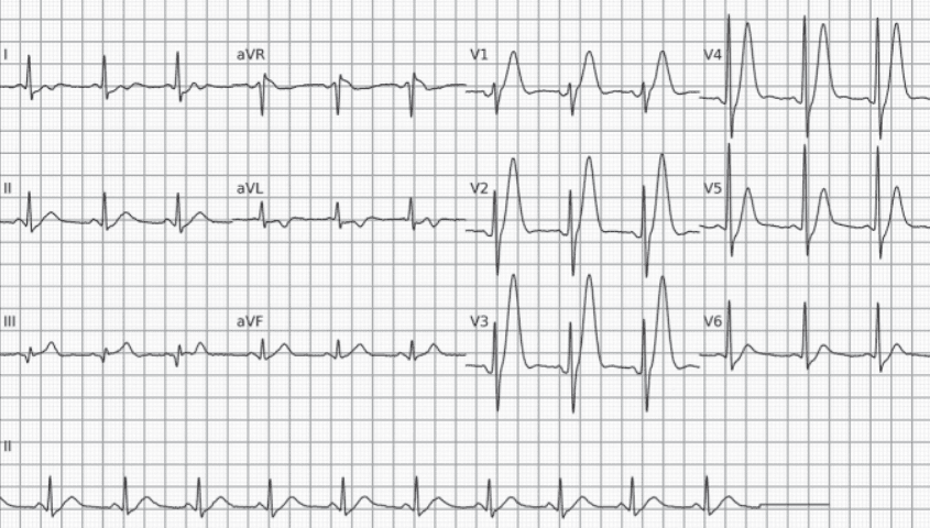 Hyperacute T wave. Large, broad-based, symmetric T waves in the horizontal plane leads.