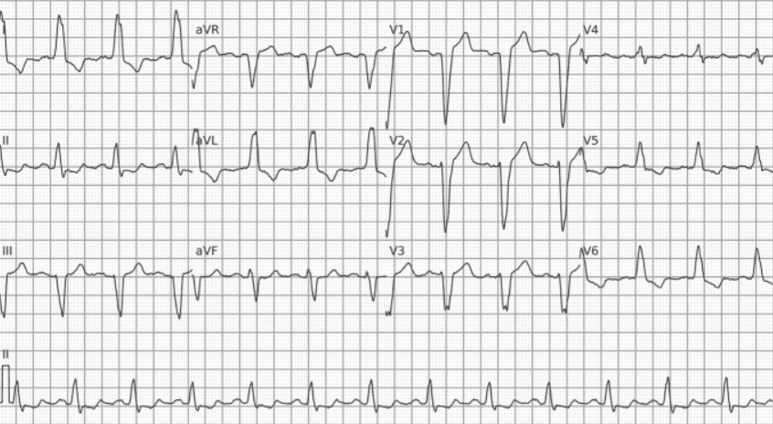 Left bundle branch block. Note the secondary ventricular repolarization abnormalities.