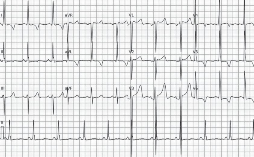 Left ventricular hypertrophy. ECG showing hypertrophy together with the strain pattern.