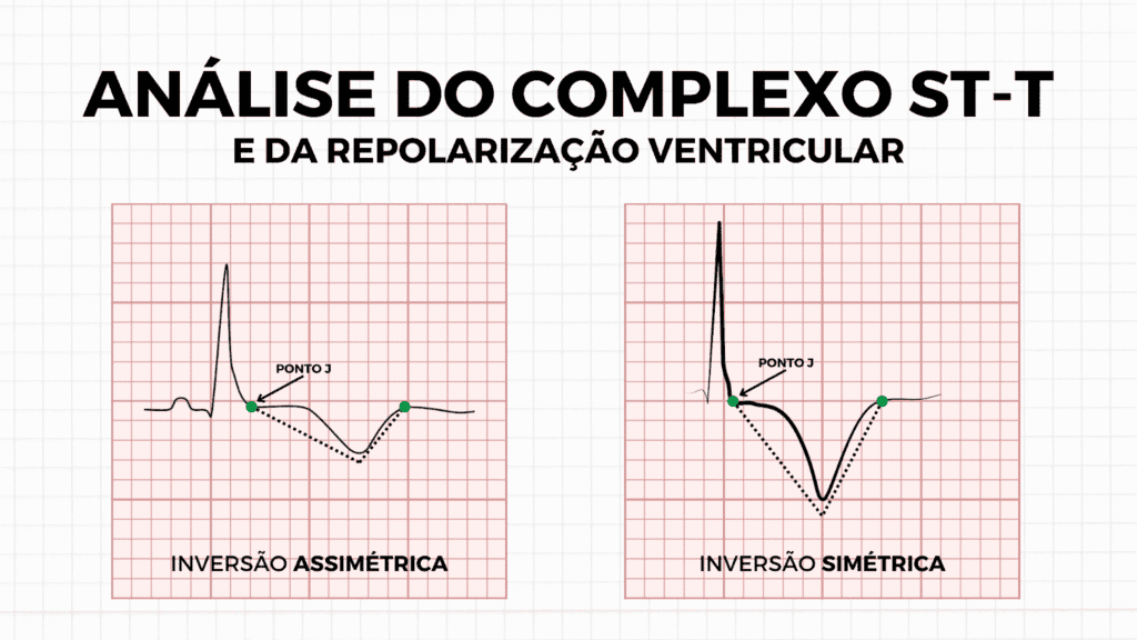 Comparison between a symmetric T wave and an asymmetric T wave in the assessment of ventricular repolarization