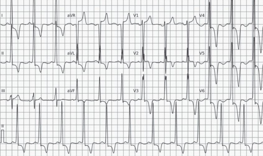 Yamaguchi syndrome. Voltage criteria for left ventricular hypertrophy and giant negative T waves (> 10 mm).
