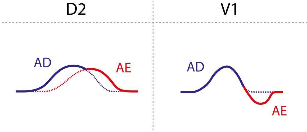 P-wave components in lead II and V1: initial right atrial activation and terminal left atrial activation, negative in V1