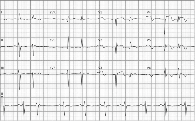 ECG showing QS complexes from V1 to V5, indicating an anteroapical electrically inactive area. Together with this, chronic ST elevation from V1 to V5 suggests a left ventricular aneurysm.