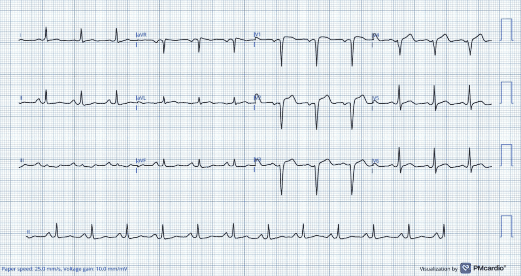 Acute occlusion of the Left Anterior Descending artery correctly identified with the help of the criteria. Note the T/QRS ratio ≥ 0.36 in V4 and ΣT/ΣQRS ≥ 0.22 (sum from V1 to V4), indicating an evolving anterior wall MI.