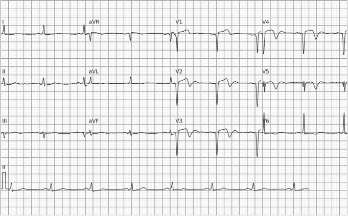 QS complexes in leads V1 to V4, indicating an anteroapical electrically inactive area, with chronic ST elevation. There are diffuse secondary repolarization changes, including biphasic, terminally inverted T waves from V1 to V4, inverted T waves in V5 and V6, and flattened T waves in I and aVL.