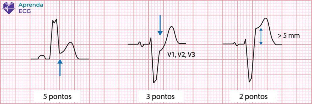 sgarbossa criteria