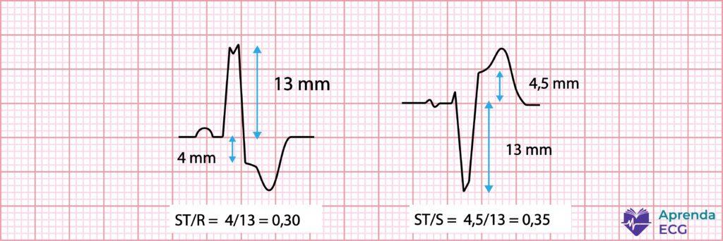 Modified Sgarbossa criterion