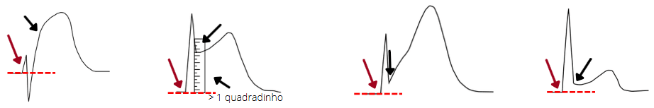 Four schematic examples of ST-segment elevation measured from the baseline
