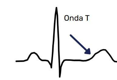 Schematic PQRST complex with an arrow pointing to the T wave, after the QRS complex