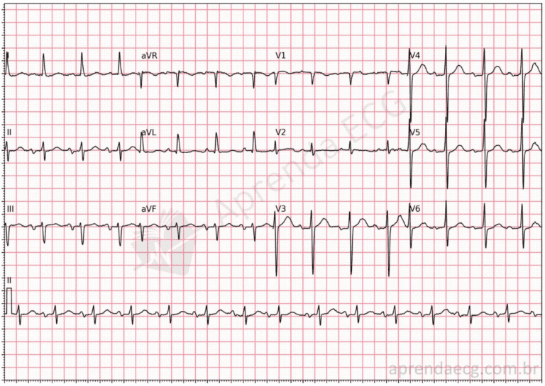 Bloqueio Divisional Anterossuperior