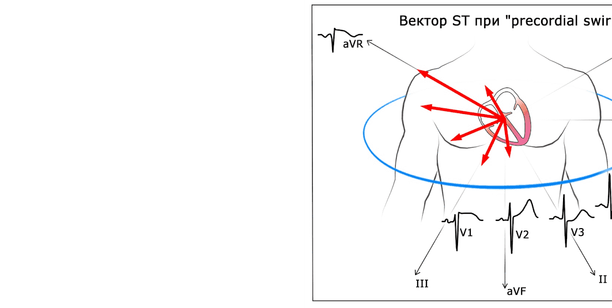 Critério de Peguero-Lo Presti: Um Novo Olhar para a Sobrecarga Ventricular Esquerda