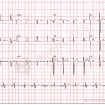 Áreas Eletricamente Inativas (Ondas Q patológicas)