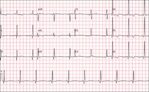 Desafio ECG #1: O que explica esse padrão de QRS observado em V1?