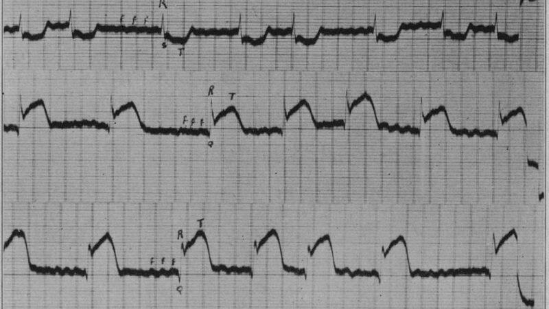 Padrão de de Winter e sua Evolução Dinâmica no Infarto Agudo do Miocárdio