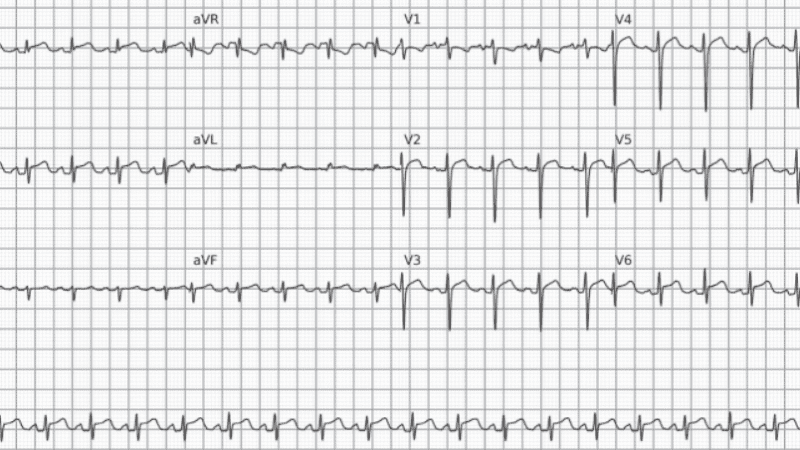 Padrão de Repolarização Precoce