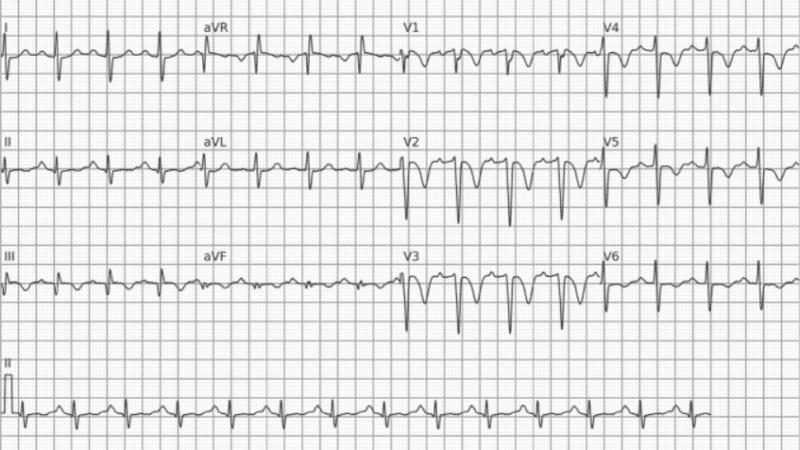Algoritmos para Diagnóstico Diferencial nas Taquicardias de QRS Largo