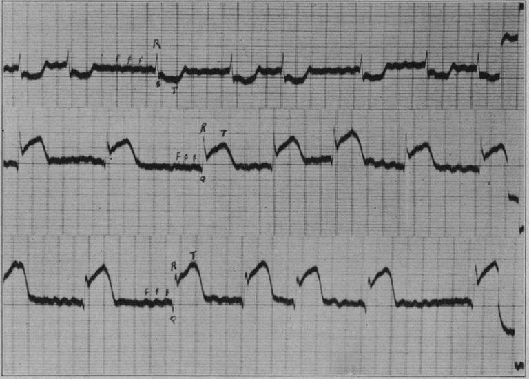 Padrão S1Q3T3: Qual a real importância desse achado?