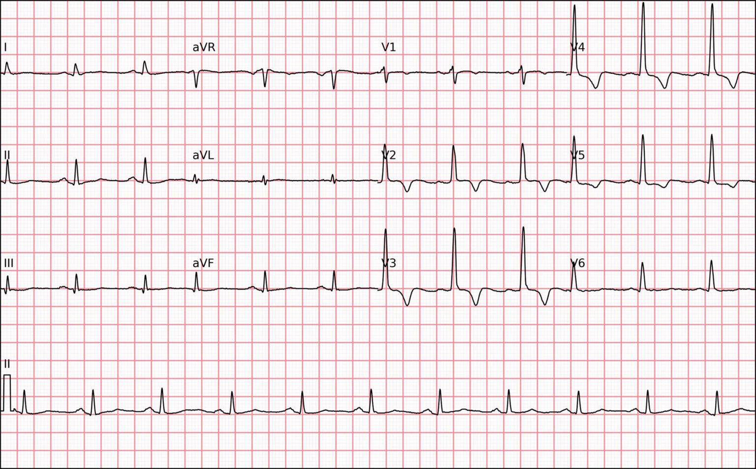Taquicardia por Reentrada Nodal vs Taquicardia por Reentrada Atrioventricular Ortodrômica