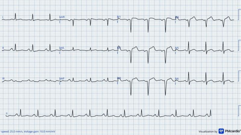 Desafio ECG #5 Você reconhece essa arritmia no ECG?