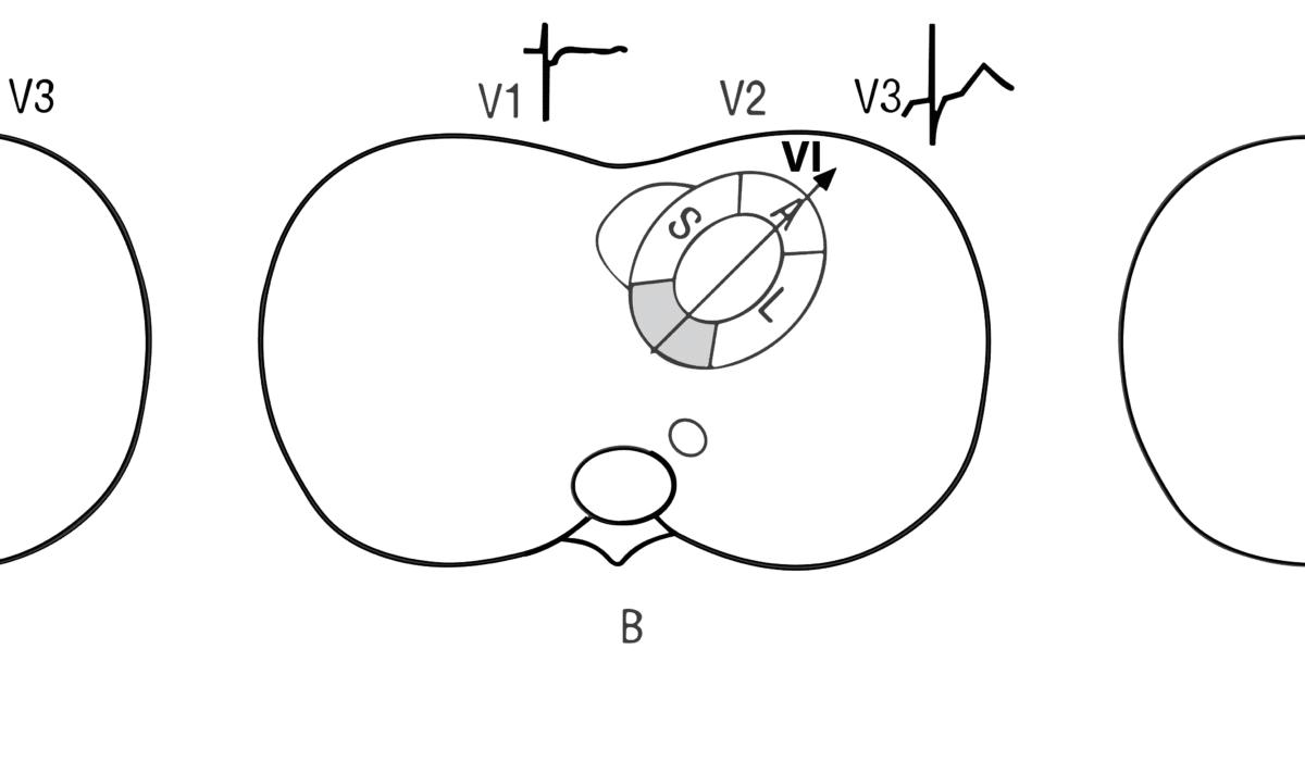 Flutter Atrial: guia completo para acadêmicos de medicina