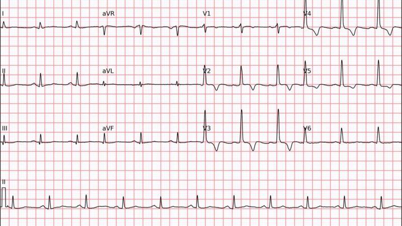 Algoritmos para Localização de Vias Acessórias: Entenda, Compare e Conheça o EPM