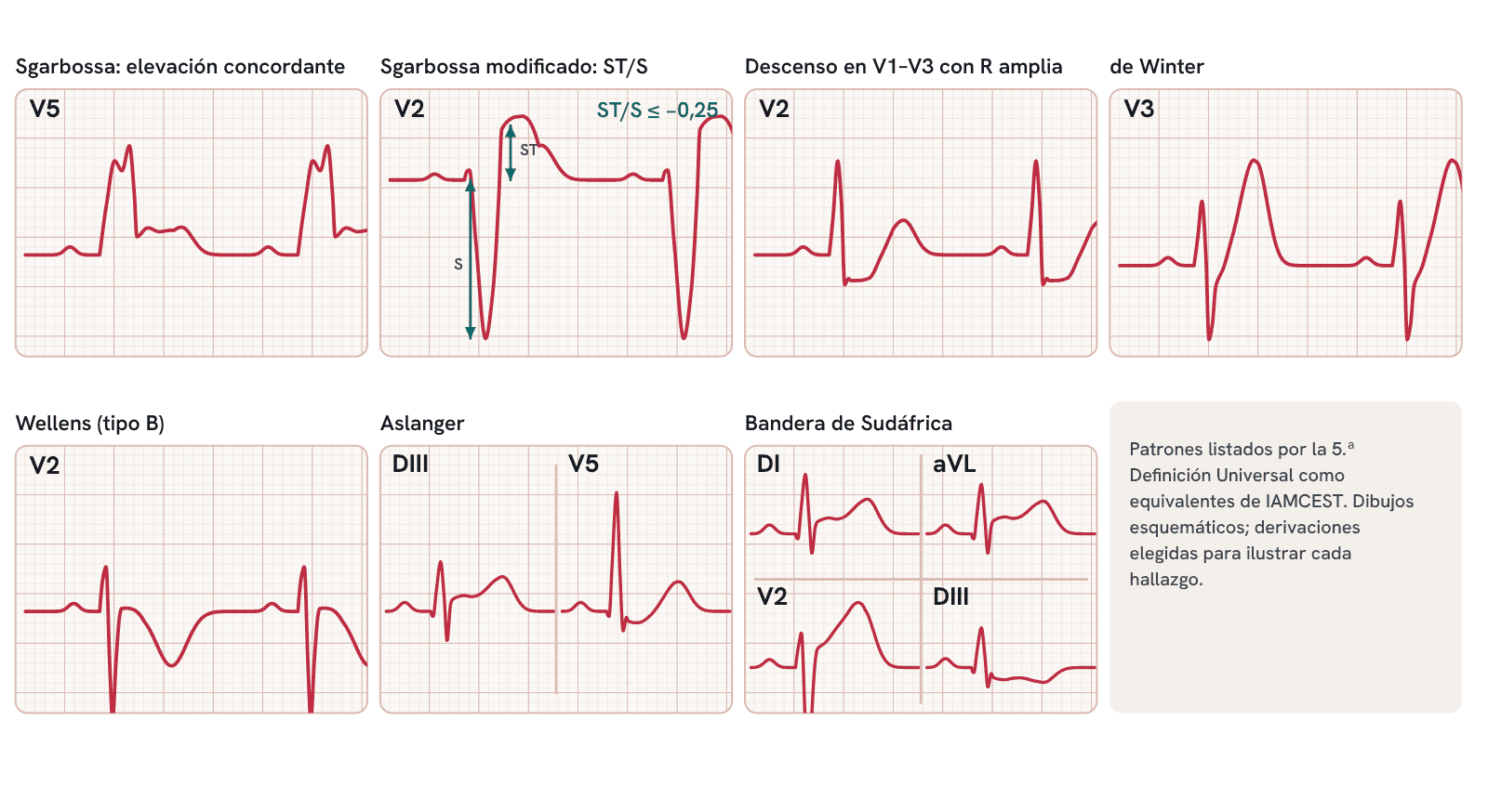 Equivalentes de IAMCEST citados por la 5.ª Definición Universal: Sgarbossa, Sgarbossa modificado, descenso en V1–V3 con R amplia, de Winter, Wellens, Aslanger y bandera de Sudáfrica.