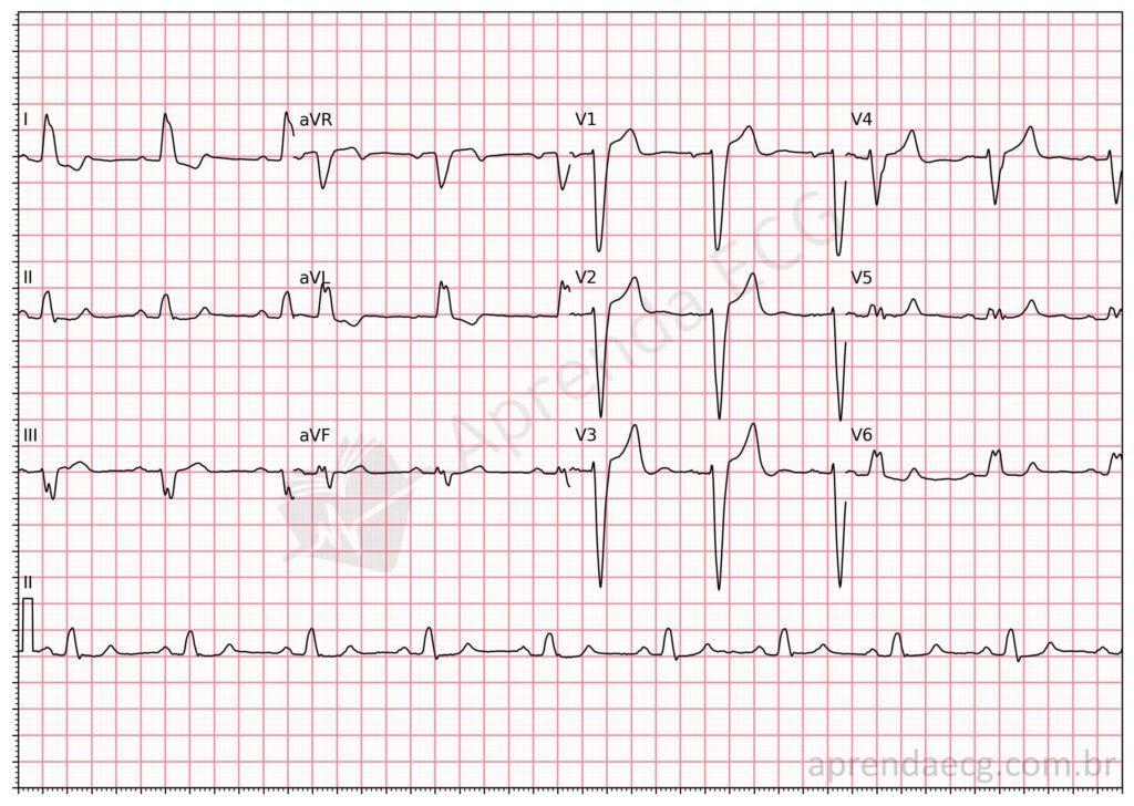Electrocardiogram showing left bundle branch block