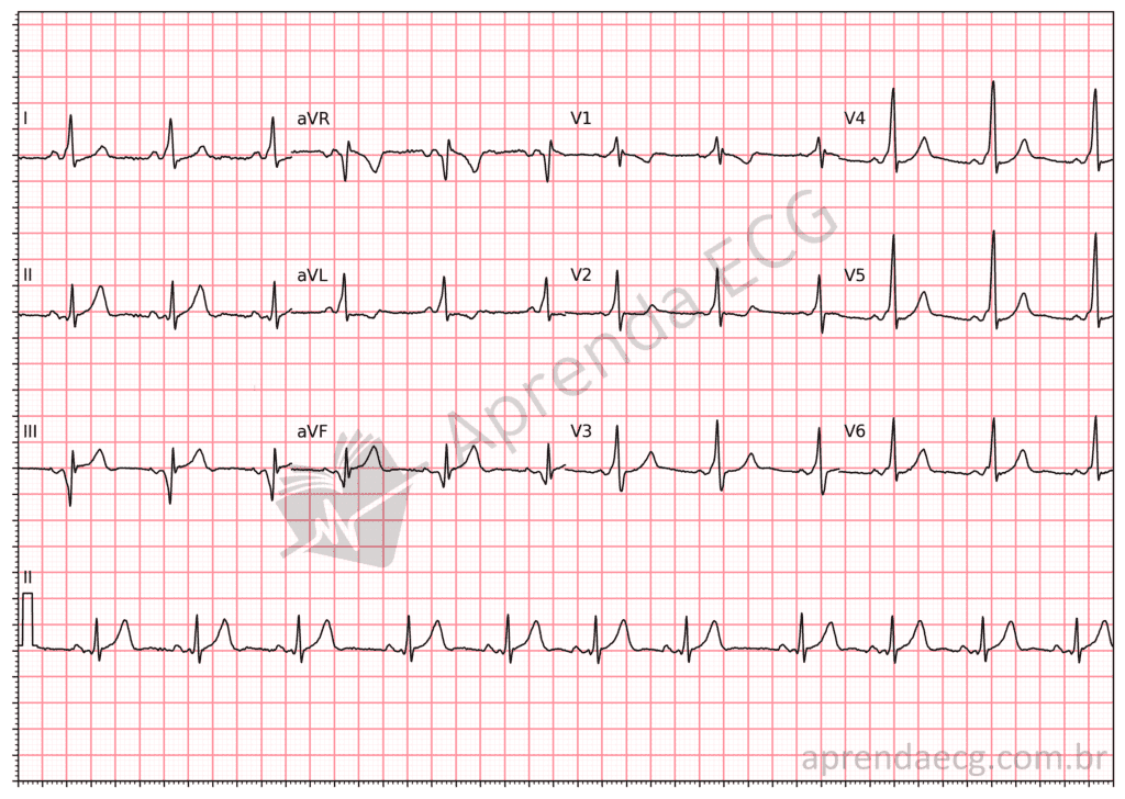 Electrocardiogram with ventricular preexcitation