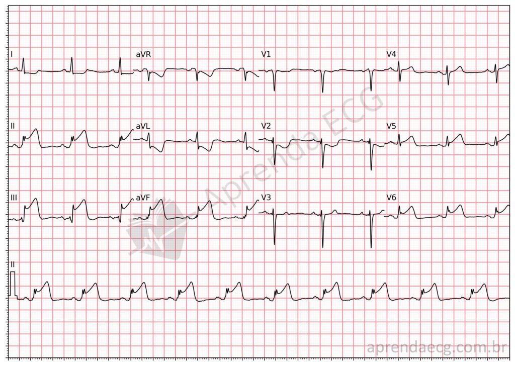 Electrocardiogram with ST-segment elevation and inferolateral wall infarction