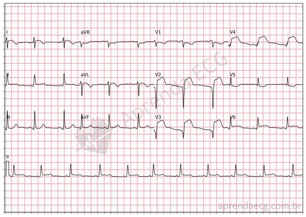 Electrocardiogram with ST-segment elevation and extensive anterior wall infarction