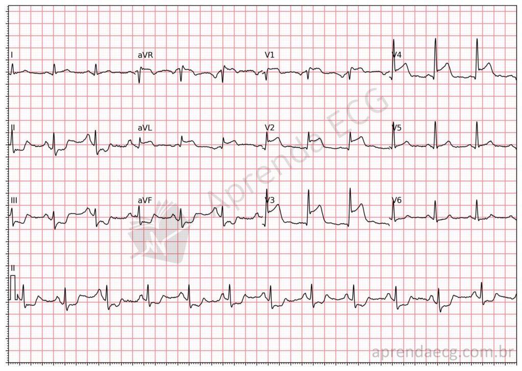 Electrocardiogram with ST-segment elevation and extensive anterior wall infarction