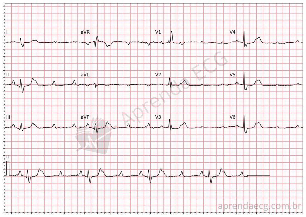 Electrocardiogram showing advanced atrioventricular block