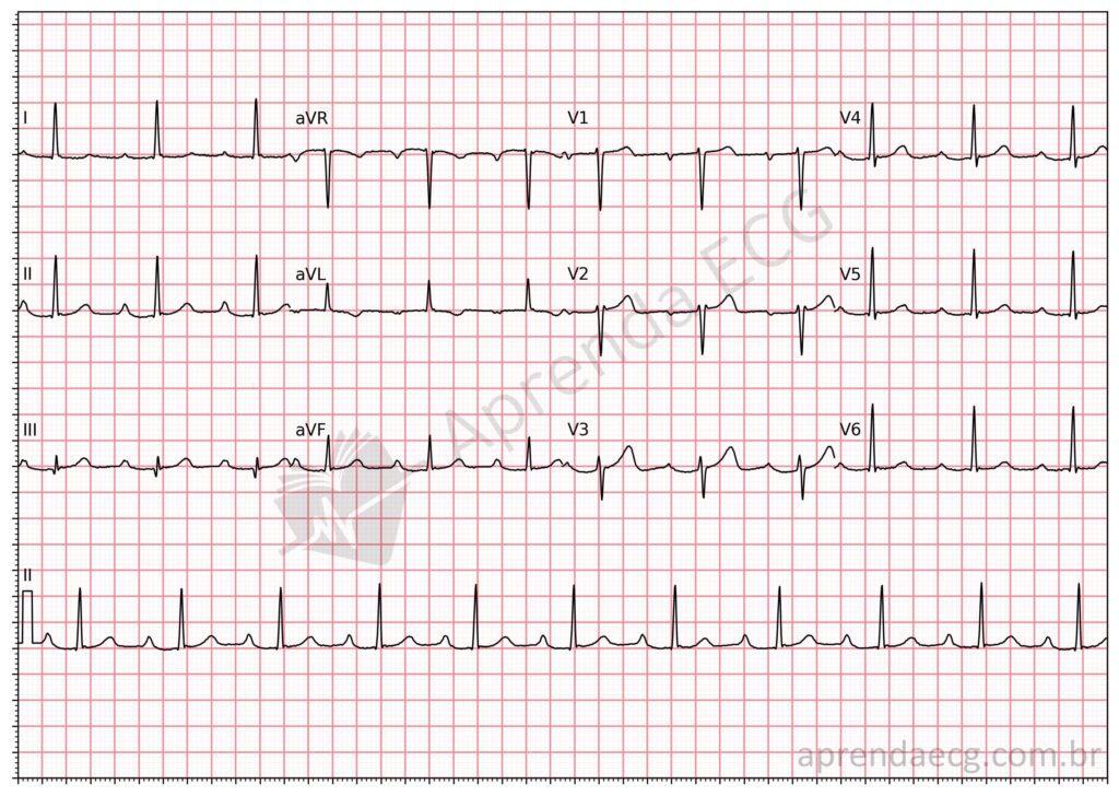 Electrocardiogram showing first-degree atrioventricular block
