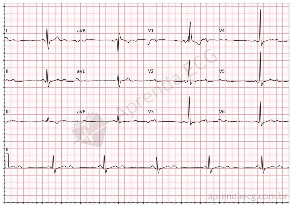 Electrocardiogram showing 2:1 atrioventricular block