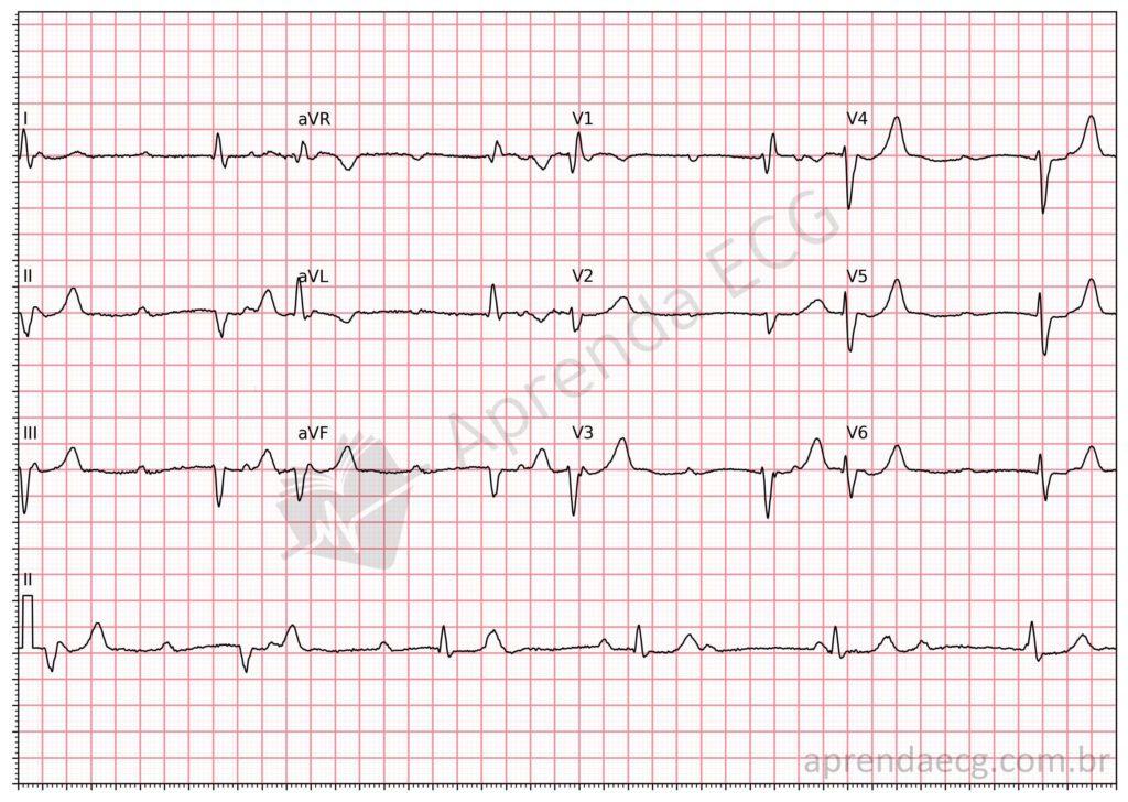 Electrocardiogram showing third-degree (complete) atrioventricular block